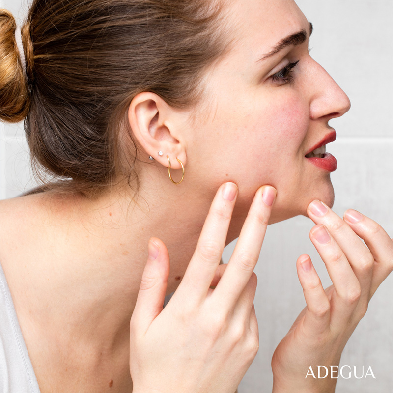 rimedi acne tea tree oil